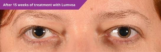 Active TED after 15 weeks of treatment with Lumvoa™ (veligrotug-vvze)