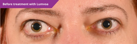 Active TED before treatment with Lumvoa™ (veligrotug-vvze)